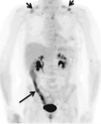 La imagen de la izquierda muestra la detección de un cáncer colorrectal y la imagen de la derecha muestra la detección de un cáncer de pulmón, ambas mediante PET.